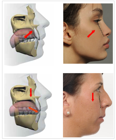 Improve Facial Structure with Correct Tongue Posture