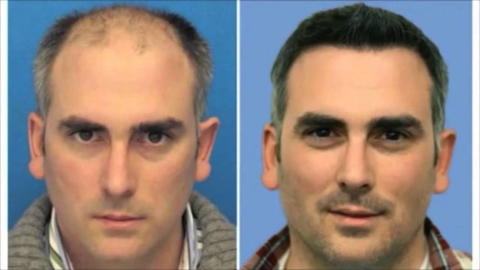 hair-transplant-result